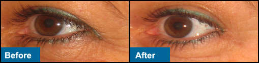 Smooth Sleepers to flatten out wrinkles (5 days)